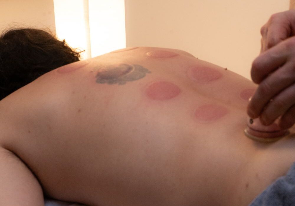 cupping-lyngby